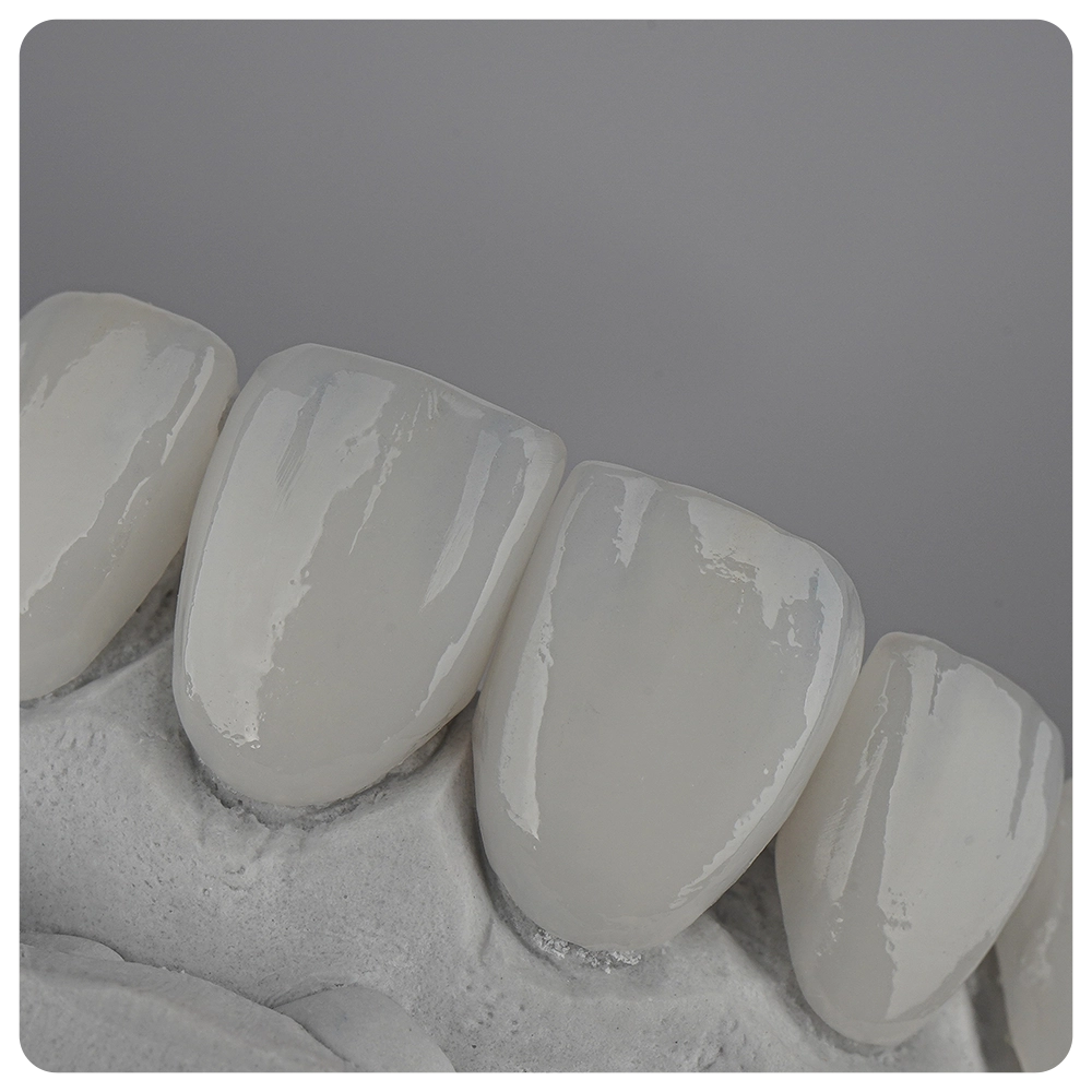 Dental Smile design White teeth ceramic Veneer Close-up super thin porcelain laminated veneer measurement with a vernier caliper to show the thickness or smile makeover treatment.