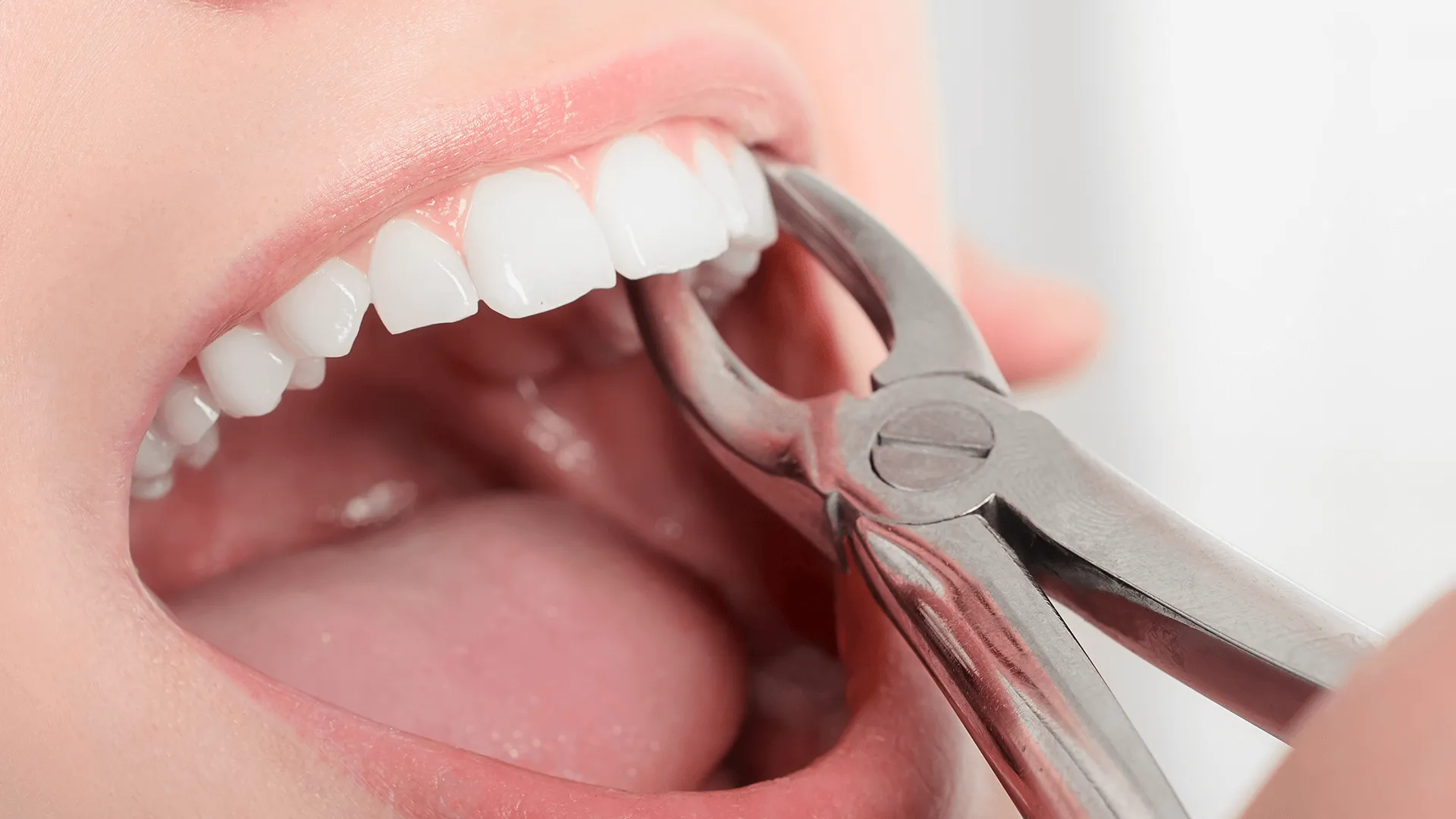 Removing the sick tooth from girls mouth