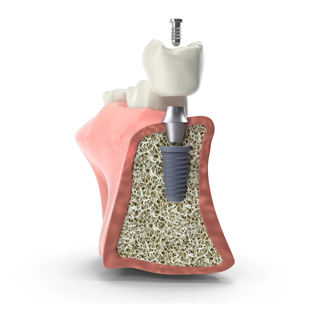 Detailed Section View of Dental Implant