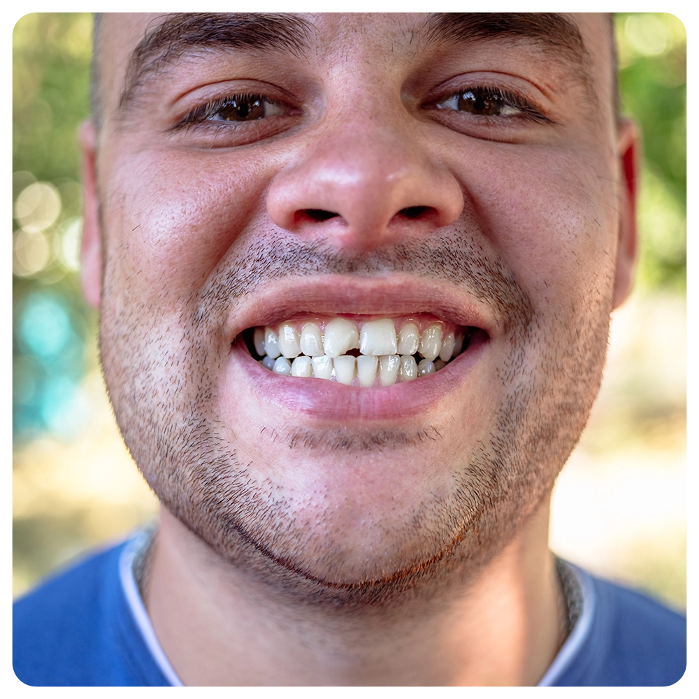 Young man in a blue T-shirt with a chipped tooth