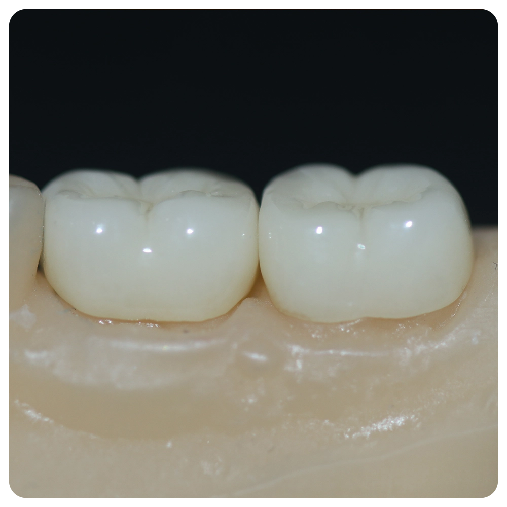 Aesthetic smile design treatment in dental dentistry. 