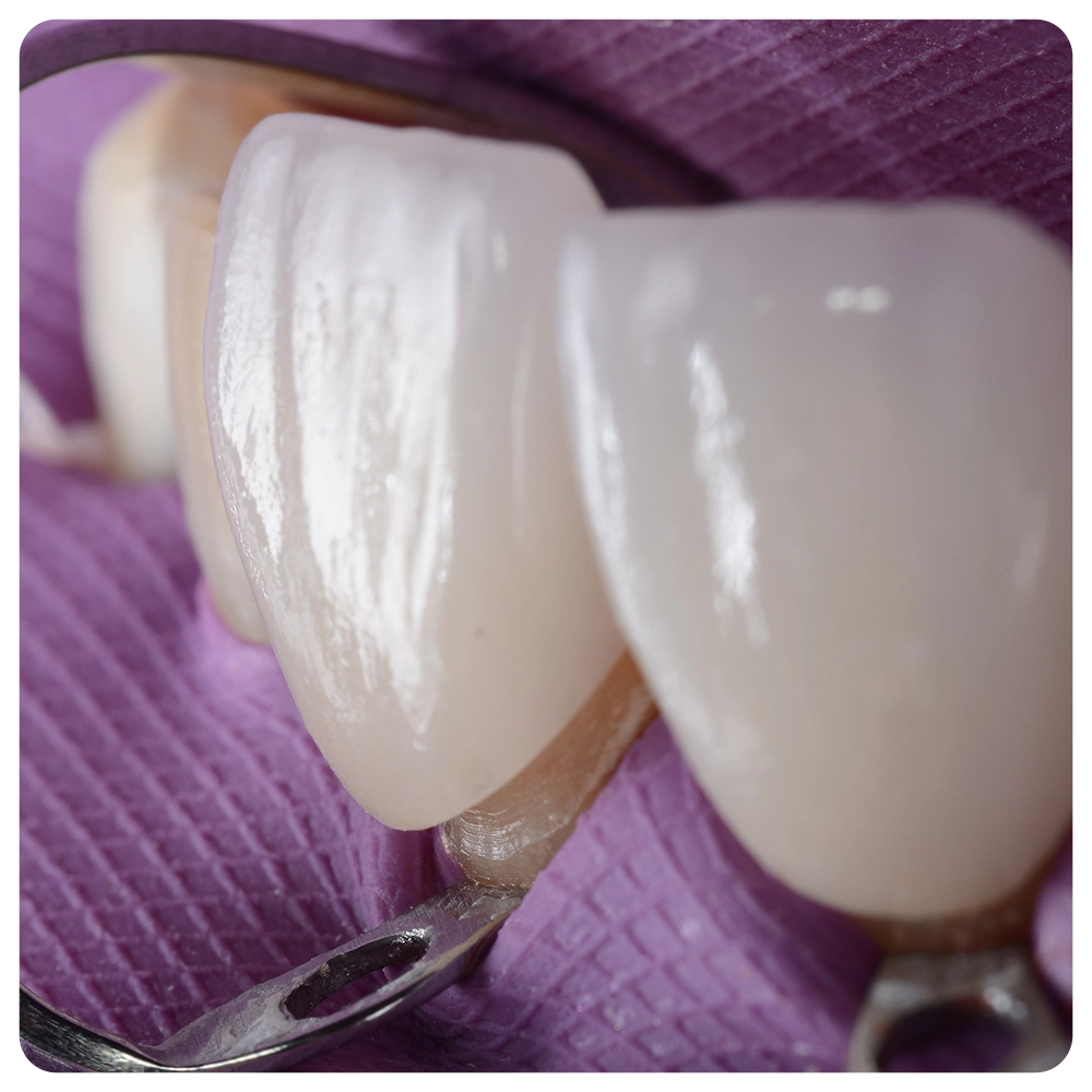 Close up shot of beautiful porcelain laminated dental veneer try in under runner dam isolation