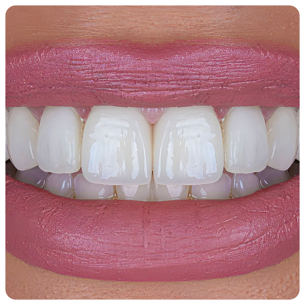 Smile design treatment in dental aesthetic dentistry with laminate veneers and dental crown restorations using computer-aided design. Dental design treatment, before-and-after, and digital design.
