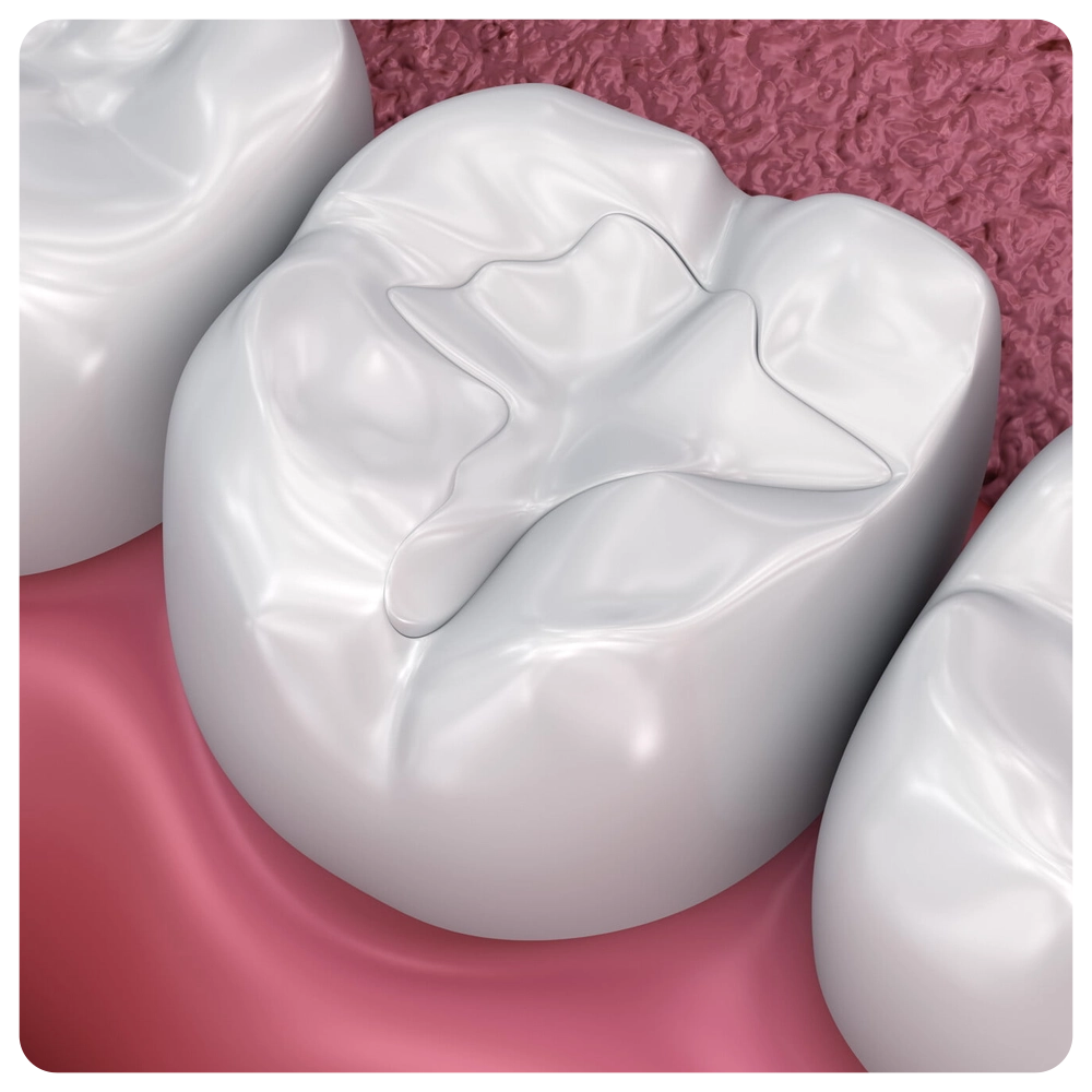 Dental fissure fillings, Medically accurate 3D illustration