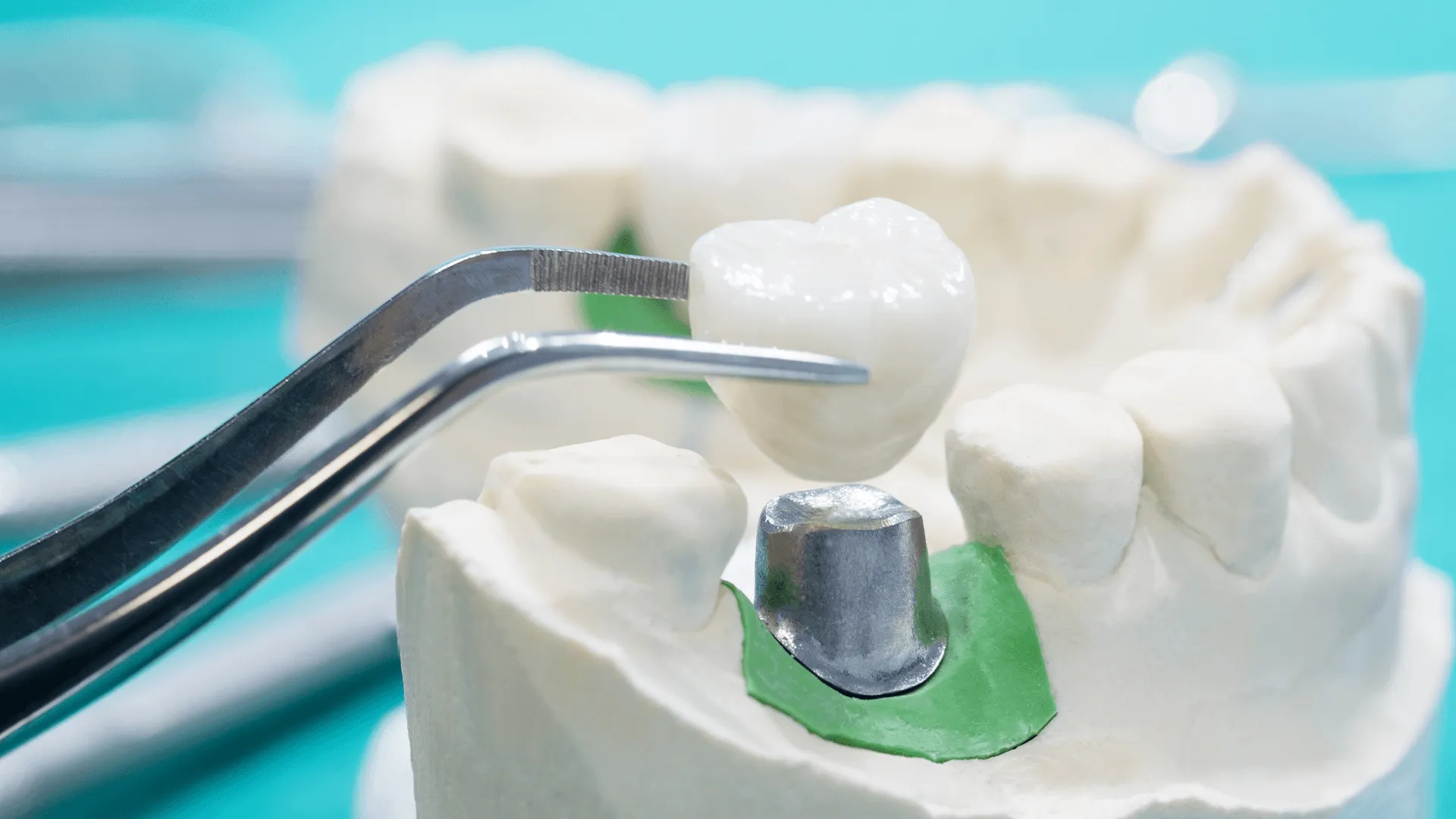 Implan model tooth support fix bridge implan and crown.