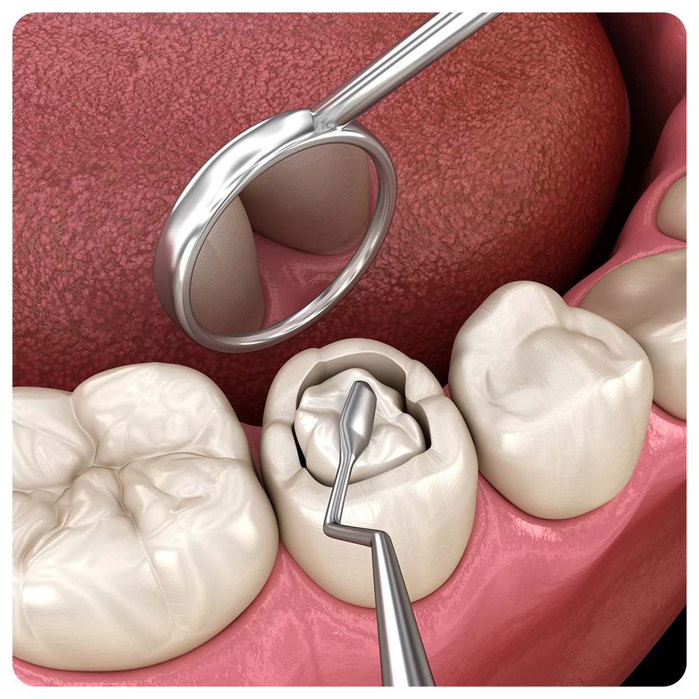 Decayed tooth restoration with composite filling. Dental 3D illustration