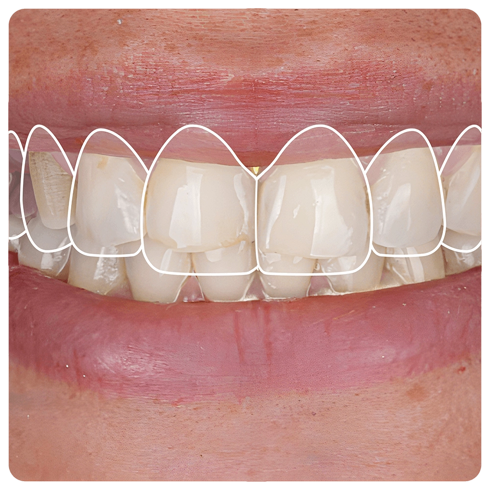 Smile design treatment in dental aesthetic dentistry with laminate veneers and dental crown restorations using computer-aided design. Dental design treatment, before-and-after, and digital design.