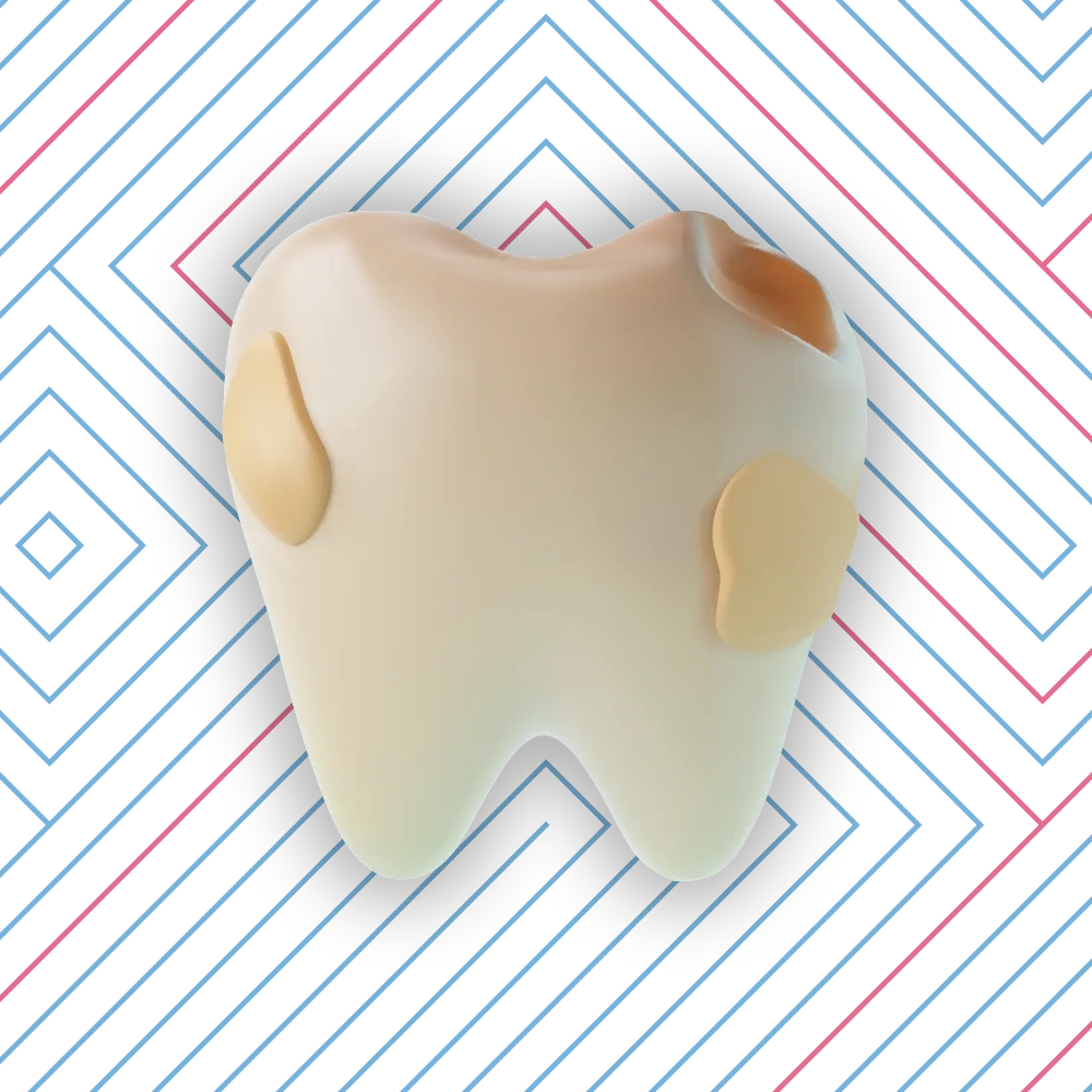 3D illustration of a stylized teeth with veneers, separated and floating against a dark blue geometric background with diagonal lines and diamond shapes.
