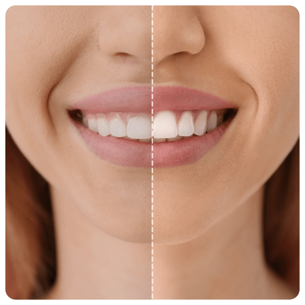 Young woman before and after procedure of gingival plasty, closeup