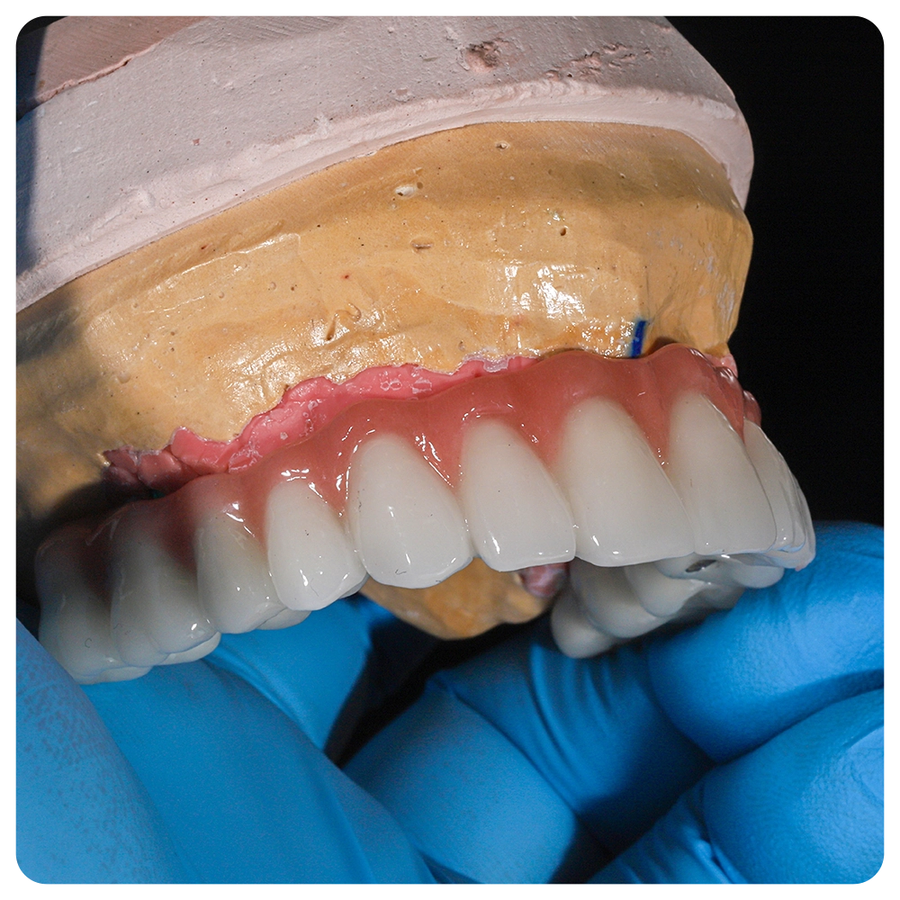 Full-arch dental prosthesis held by a dentist wearing blue gloves.