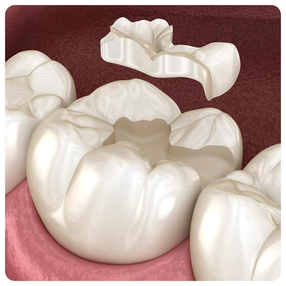 Inlay ceramic crown fixation over tooth. Medically accurate 3D illustration of human teeth treatment